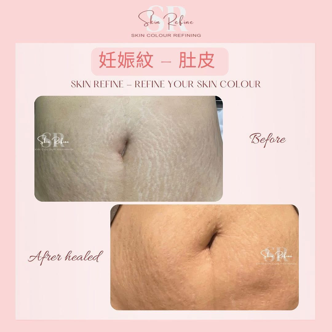Bcb_sr 半永久膚色重建術（皮紋）