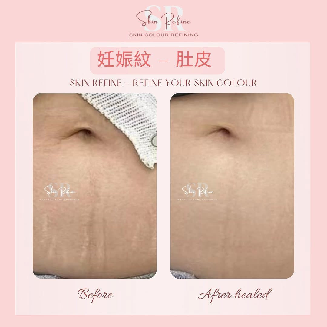 Bcb_sr 半永久膚色重建術（皮紋）