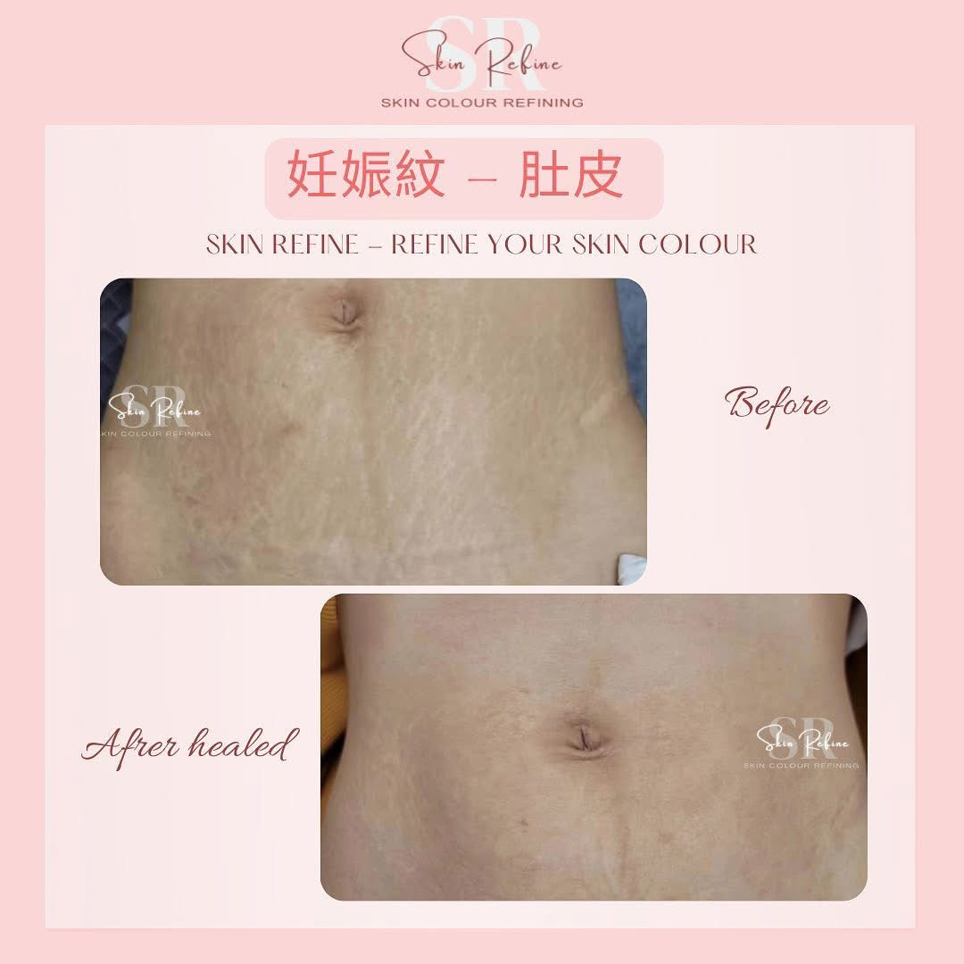 Bcb_sr 半永久膚色重建術（皮紋）